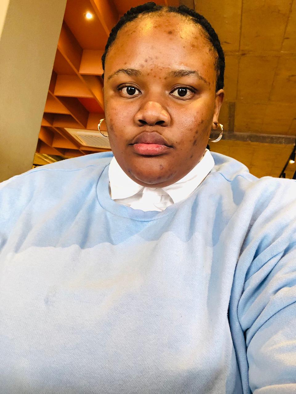 Before — Acne scars visibly reduced