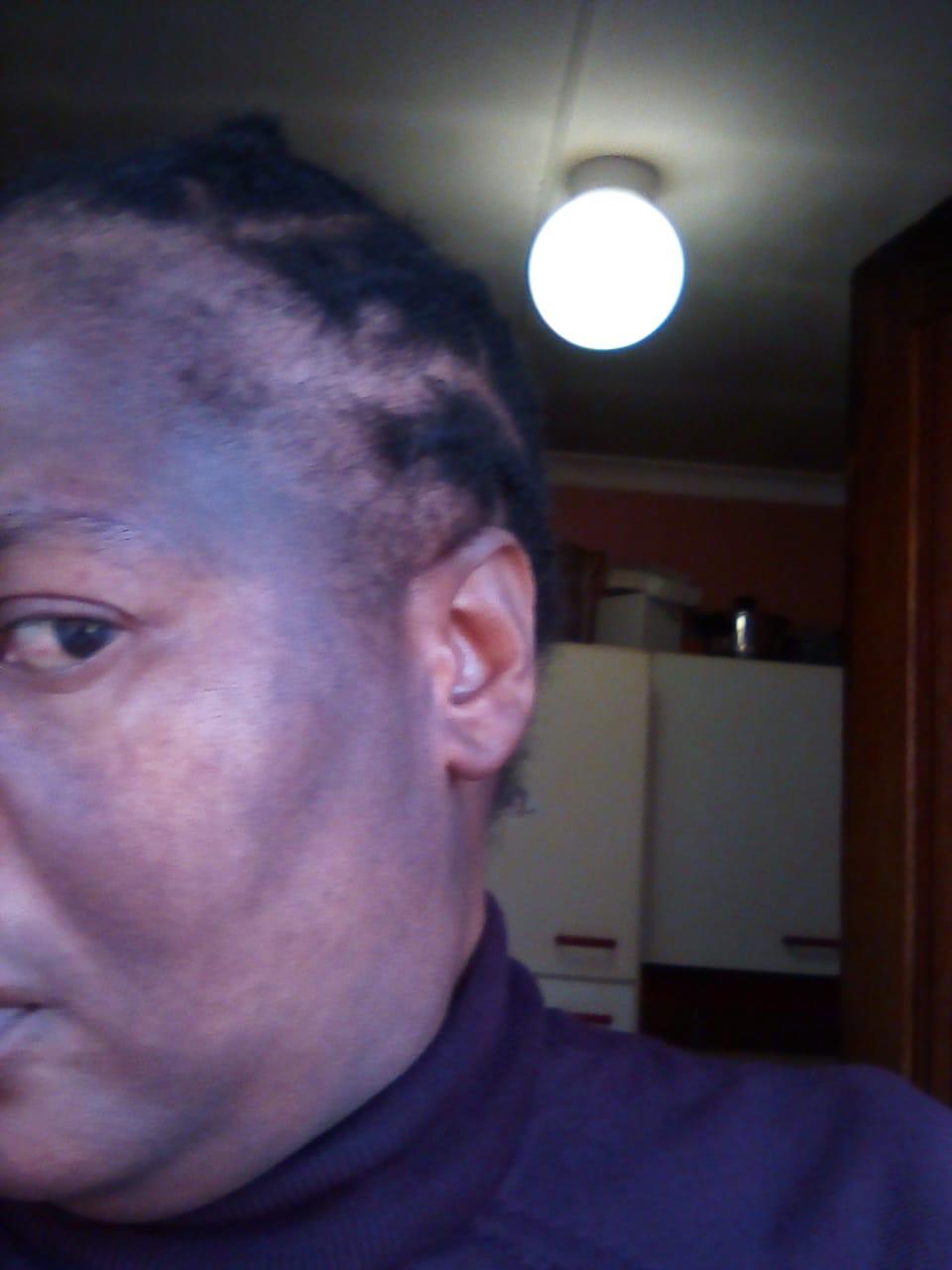 Before — Dark marks faded in 4 weeks